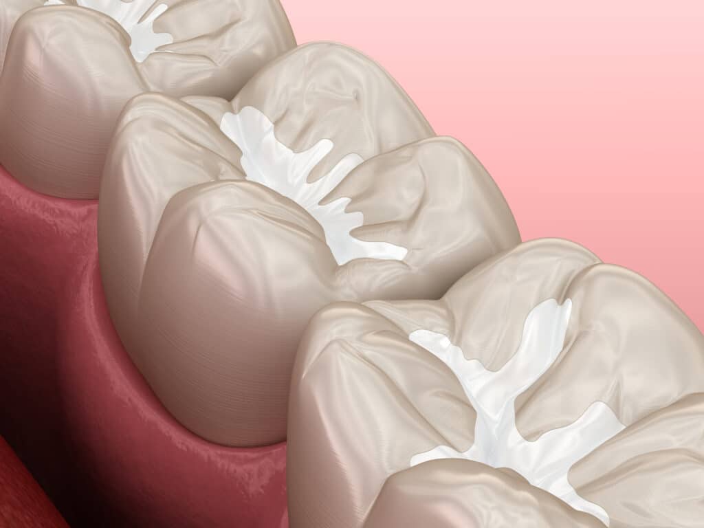 Dental Sealants Bellevue
