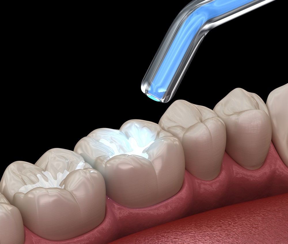 Dental Fillings Bellevue